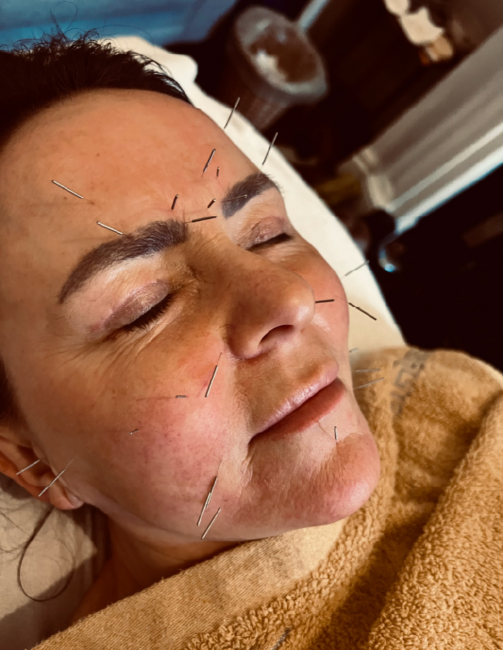 Rejuvenating Facial with Acupuncture - Emma McEvoy